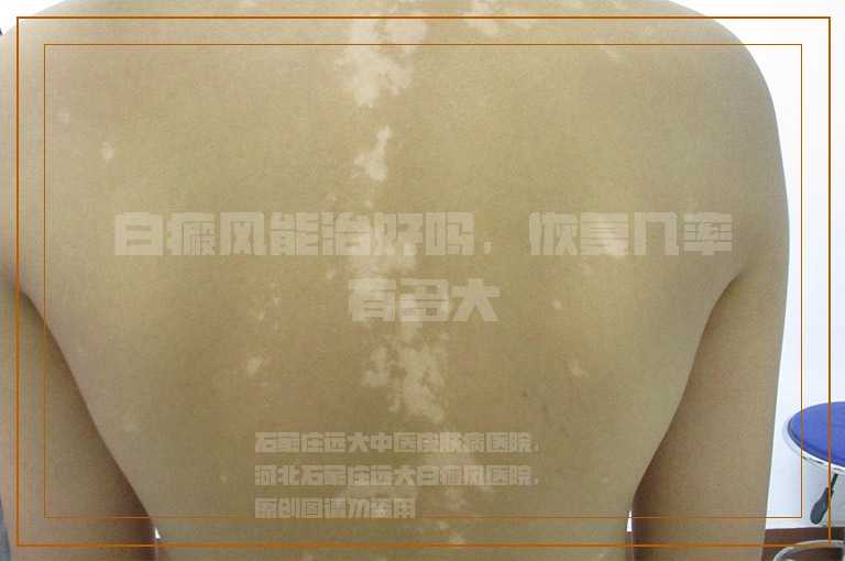 白癜风能治好吗，恢复几率有多大