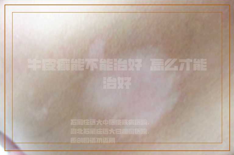 牛皮癣能不能治好 怎么才能治好
